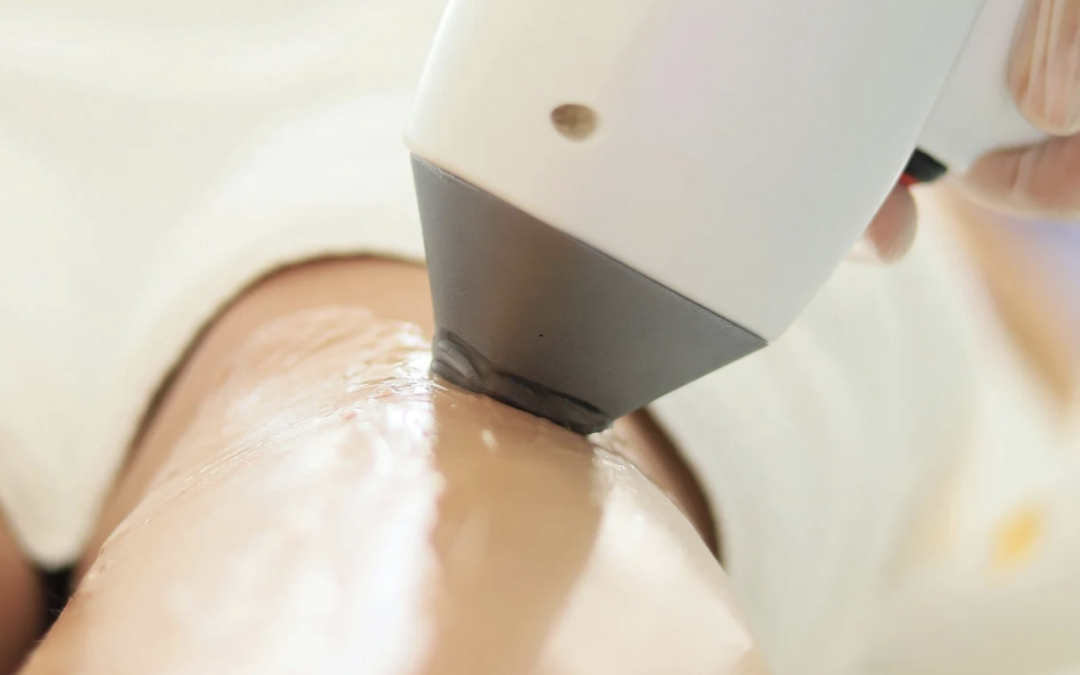 Full Body Laser Hair Removal Costs in Chevy Chase, Maryland